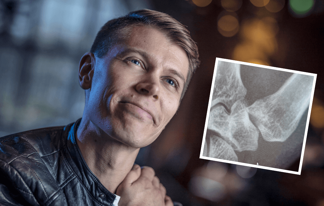 Vili Mustalampi käsi Laulaja sai aluksi väärän diagnoosin murtuneen sormen luuta piti sahata | tanssiin Fi
