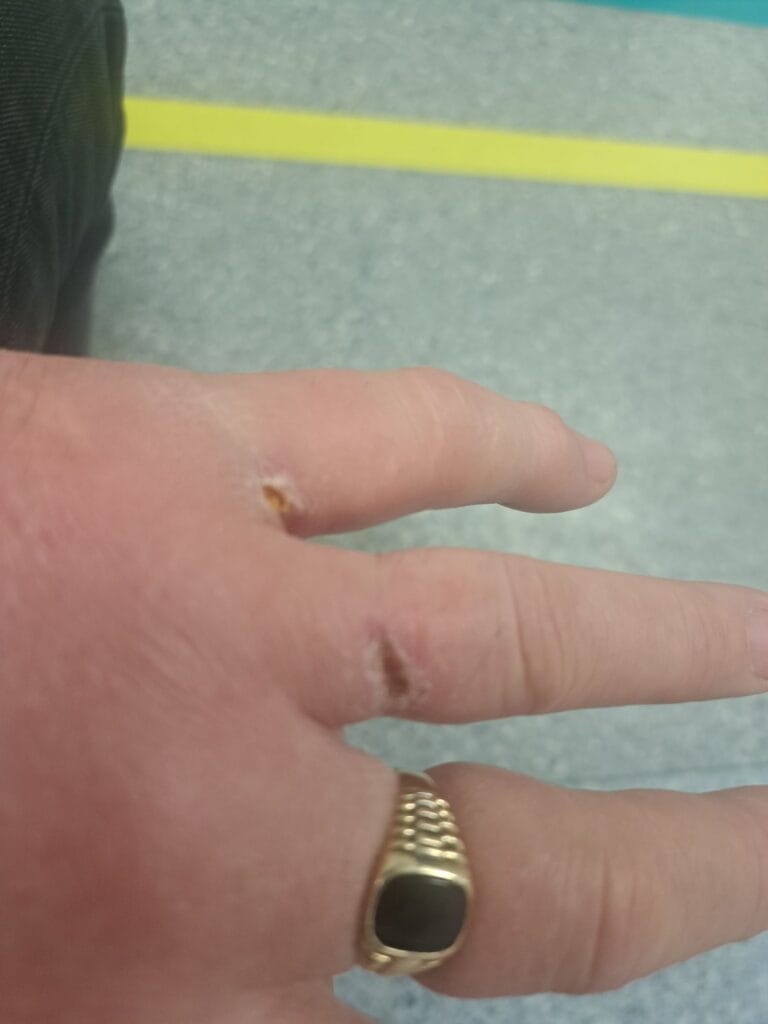 J Eskelinen käsi J Eskelisen käsi turposi rajusti epäilen että bakteeri | tanssiin Fi